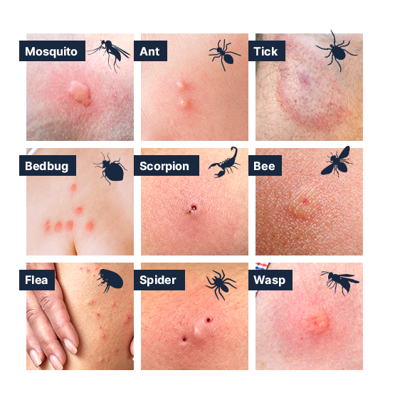 bug bites differences